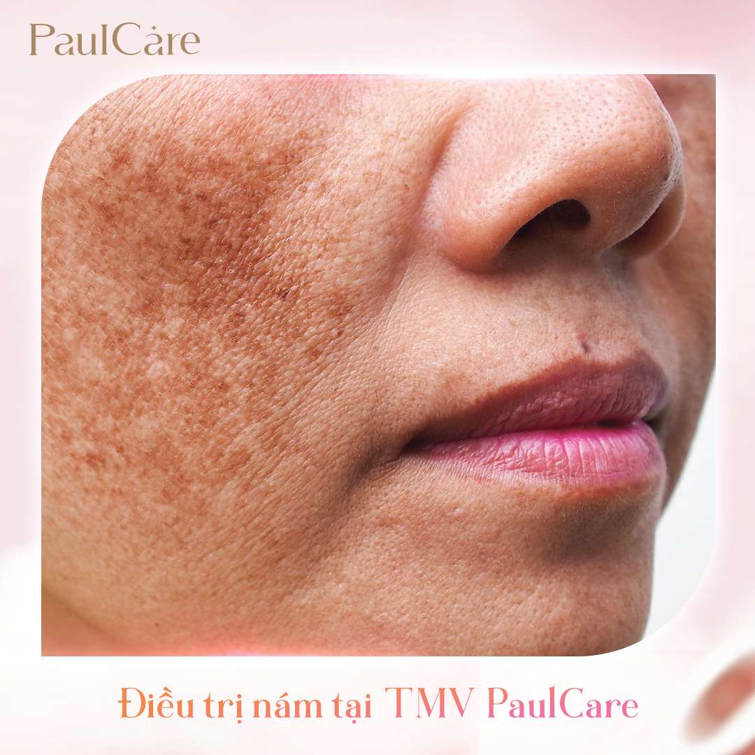 truoc_va_sau_dieu_tri_nam_paulcare (1)