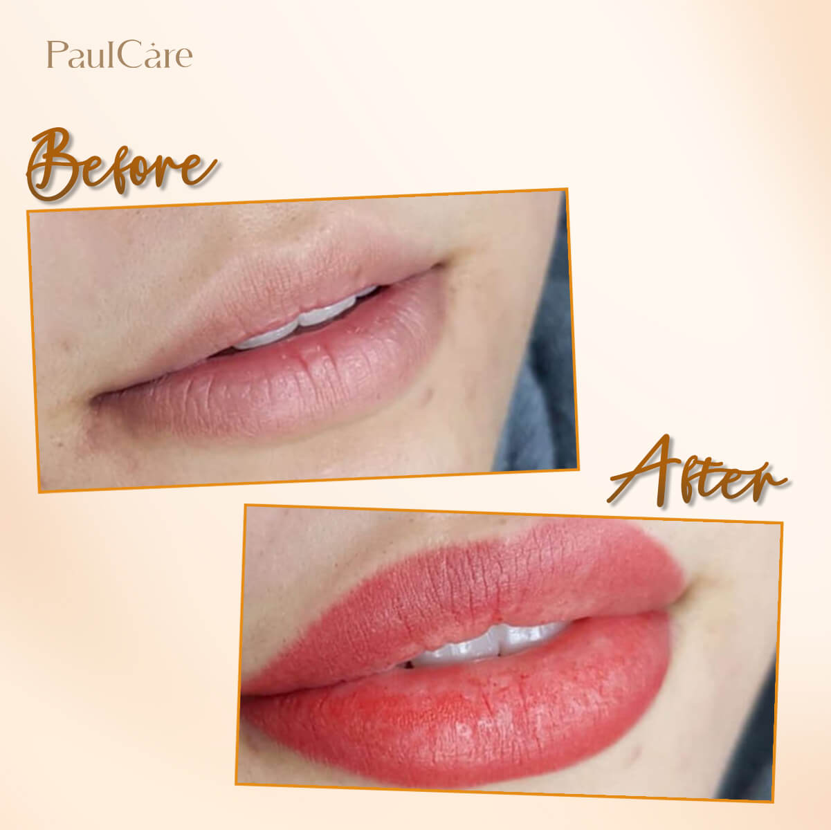 truoc_sau_cay_moi_sinh_hoc_paulcare