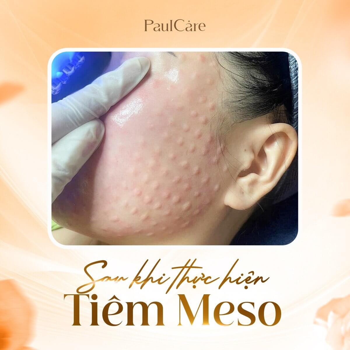 lan_da_sau_khi_tiem_meso_paulcare